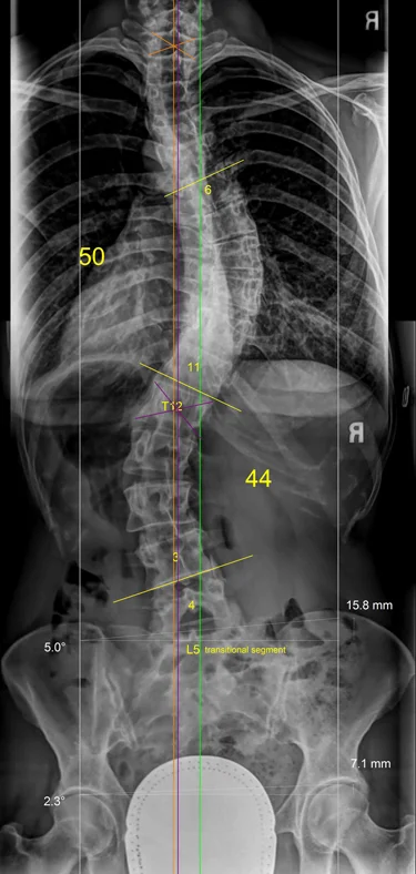 Chiropractic Victoria BC Chiropractic Care for Scoliosis