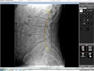 Chiropractic Victoria BC X Ray