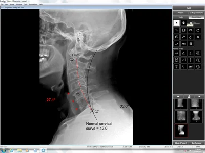 Chiropractic Victoria BC X Ray